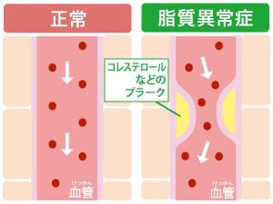 脂質異常症（高コレステロール血症）とは